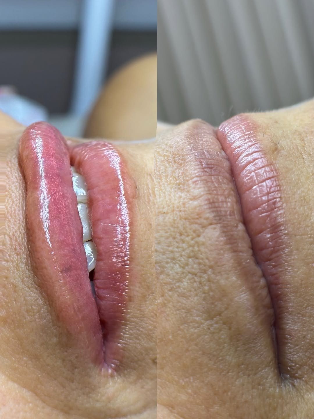 Antes e depois de micropigmentação labial