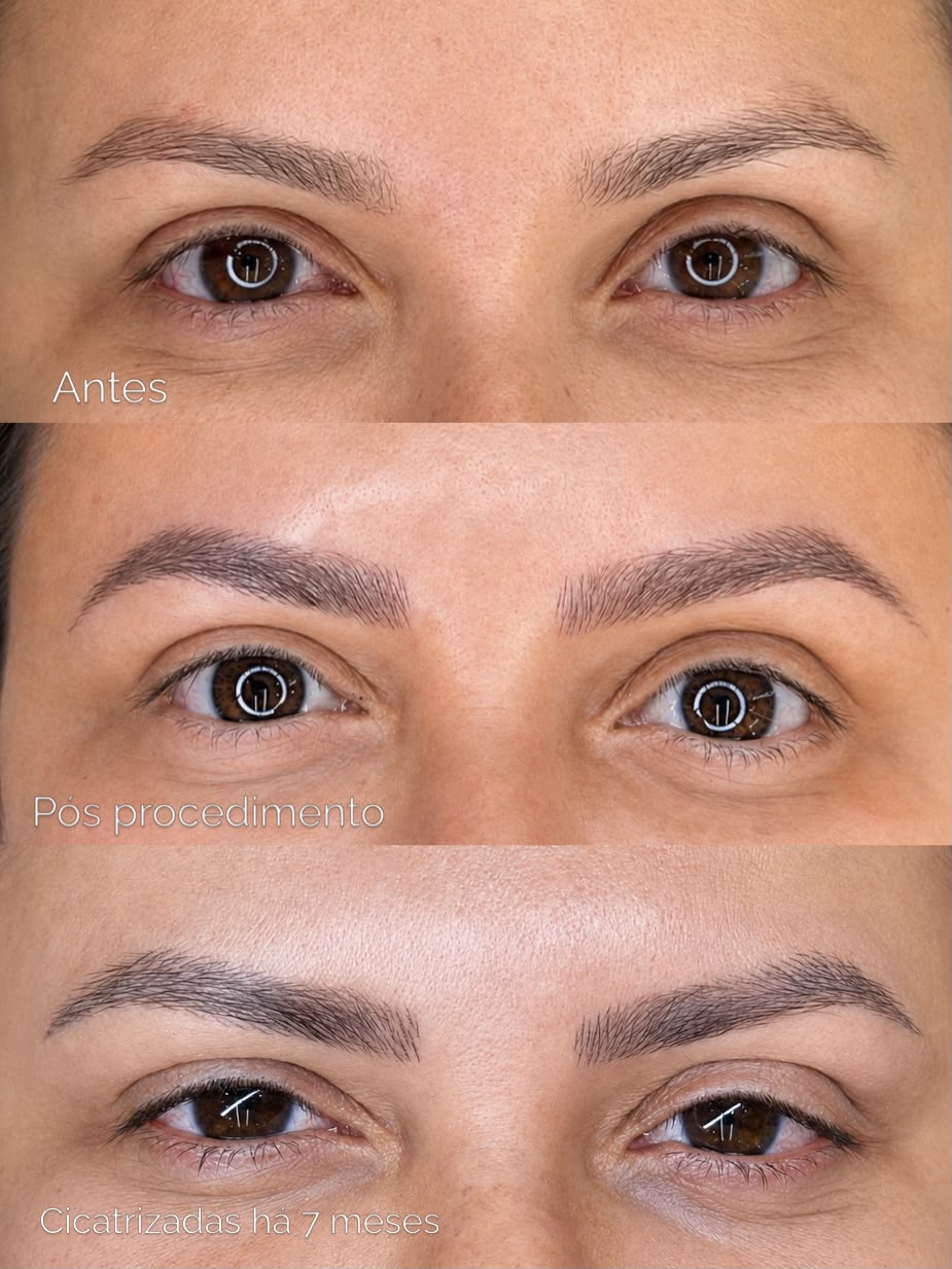 Antes e depois de micropigmentação de sobrancelhas